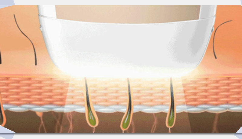 哪款脫毛儀脫毛效果好，看準(zhǔn)這幾點就夠了