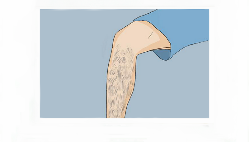 光子脫毛是永久脫毛嗎