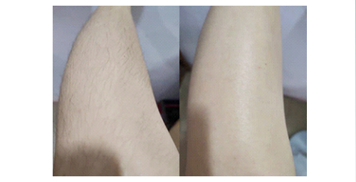 如何擺脫體毛濃密的困擾？體毛濃密女孩過來看看(圖2)