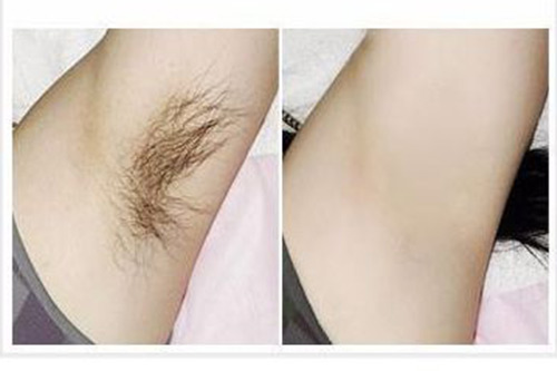 關于家用光子脫毛儀的小秘密（四）(圖1)