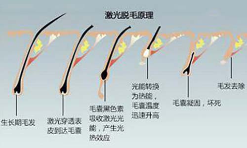 夏季脫毛：為什么有人說光子脫毛沒有效果？(圖2)