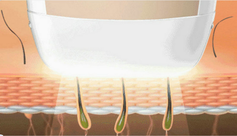 家用脫毛儀,脫毛更簡單(圖1) 家用脫毛儀,脫毛更簡單(圖1)