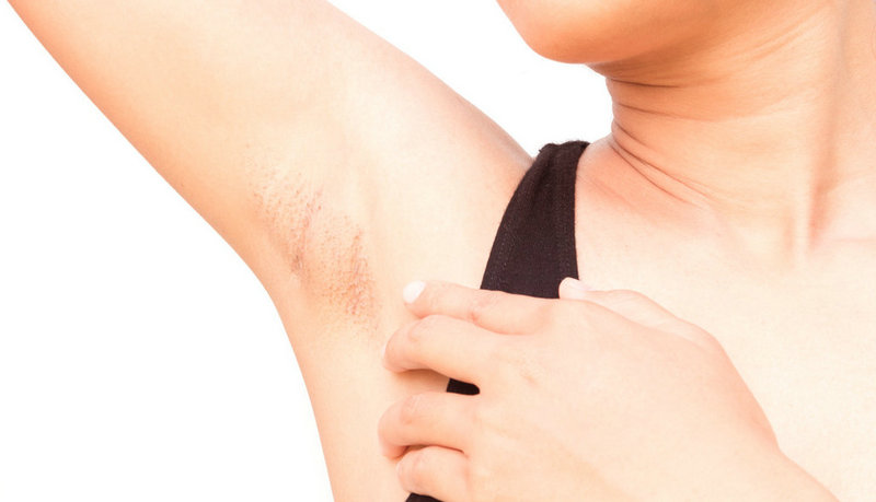 去腋毛會不會引起狐臭？有什么直接聯系嗎？(圖2)